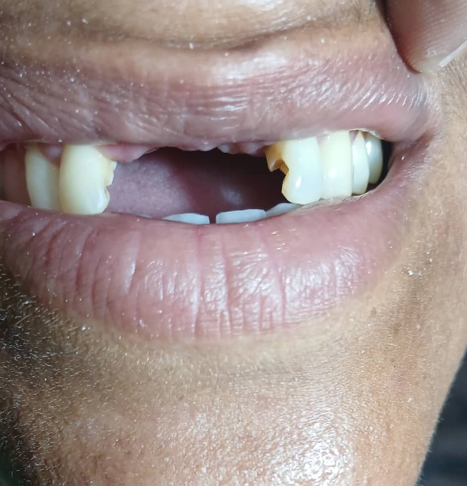 Antes del tratamiento de implante dental