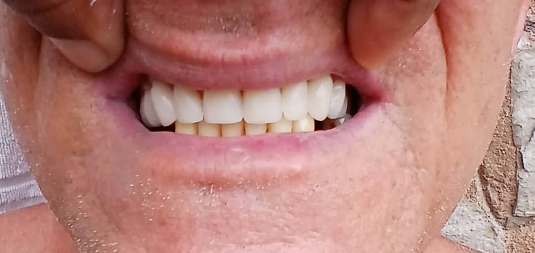 Después del tratamiento de diseño de sonrisa