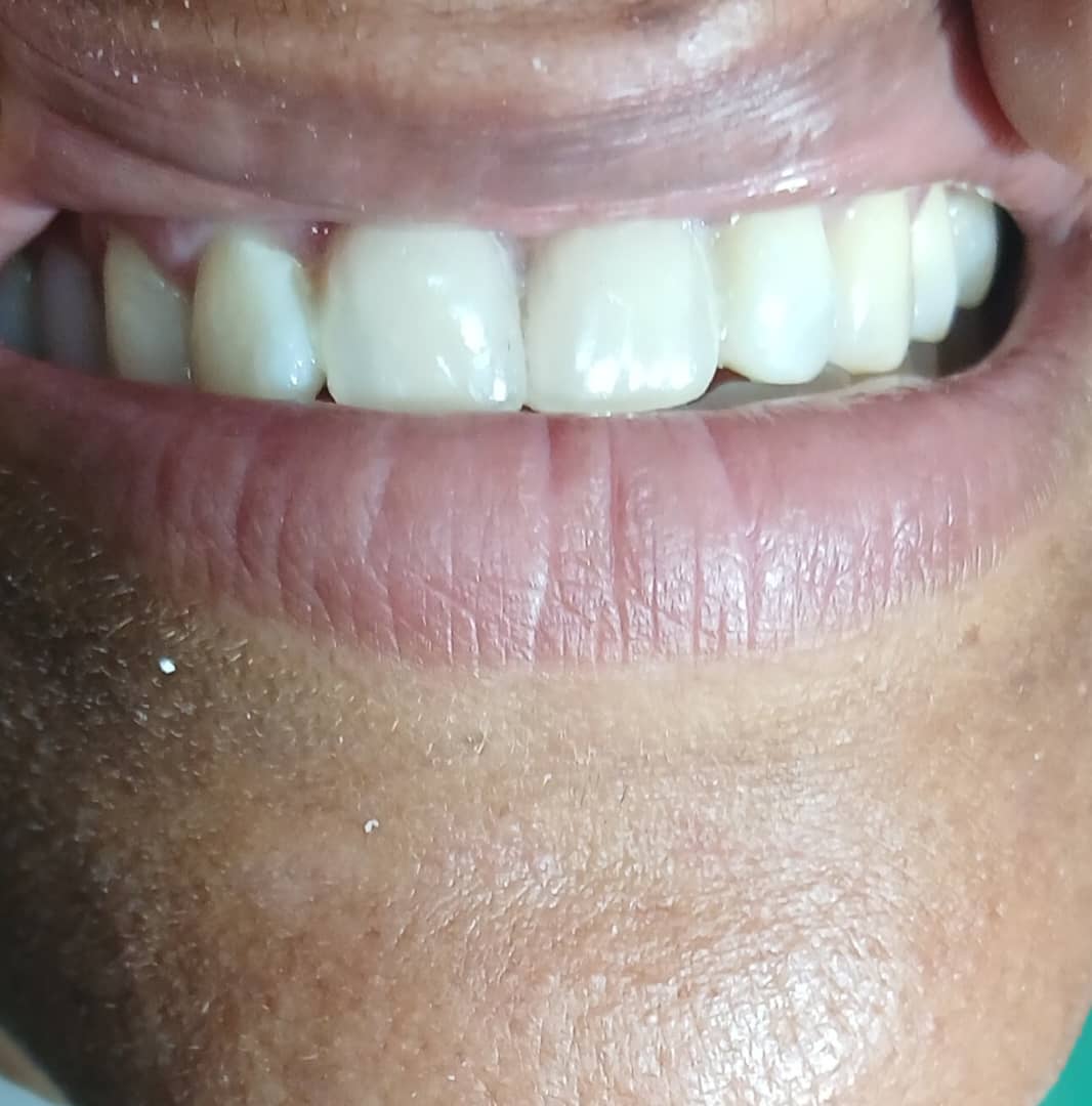 Después del tratamiento de implante dental